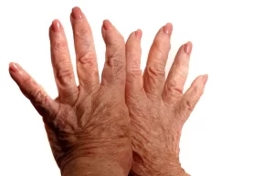 Mãos típicas de artrose